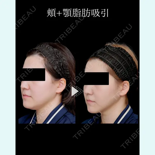 脂肪吸引ラボトウキョウ 渓 智司医師の症例