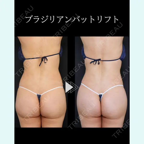 脂肪吸引ラボトウキョウ 渓 智司医師の症例