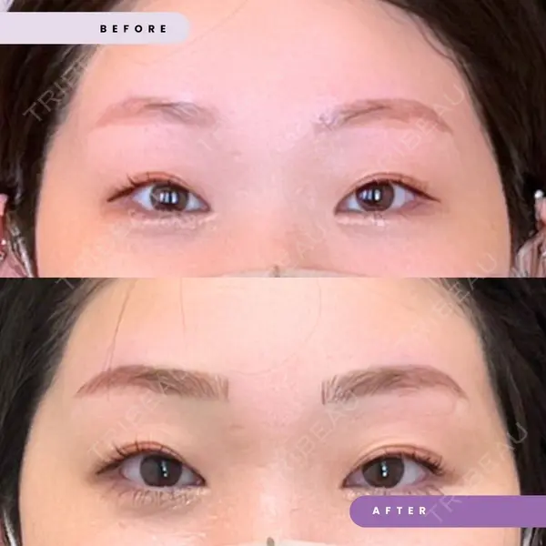 メディカルエピレーションクリニック 心斎橋院の症例