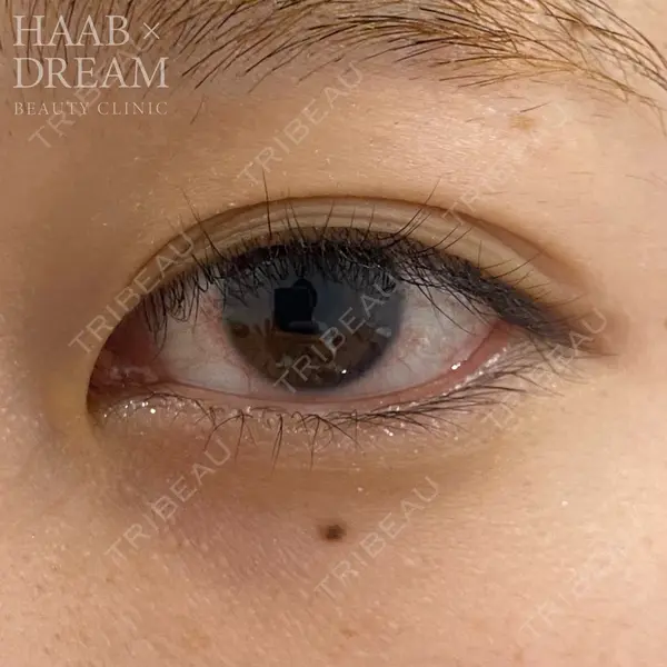 HAAB×DREAM BEAUTY CLINIC 東京本院 田中 優太医師の症例