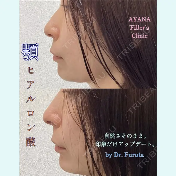 AYANAフィラーズクリニック 渋谷院 古田 晃医師の症例