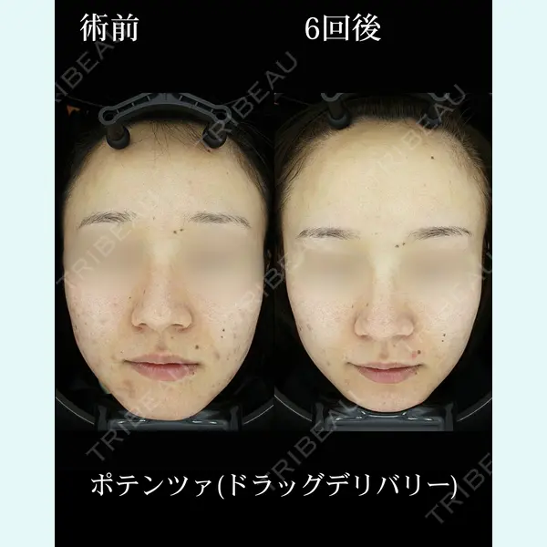 HAAB×DREAM BEAUTY CLINIC 東京本院の症例