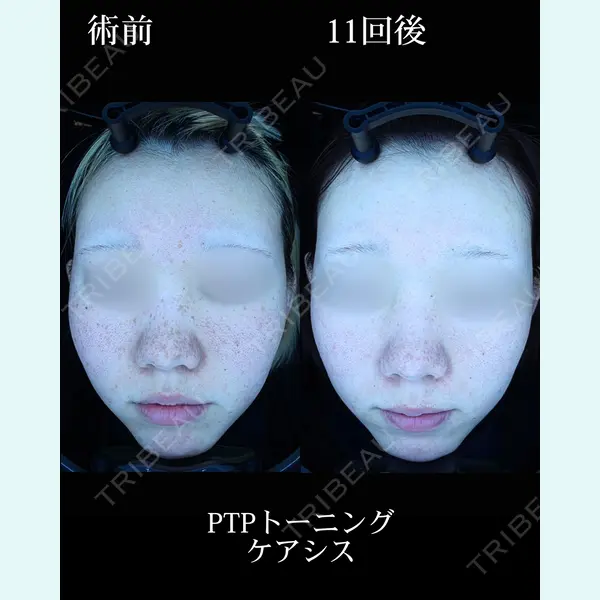 HAAB×DREAM BEAUTY CLINIC 東京本院の症例