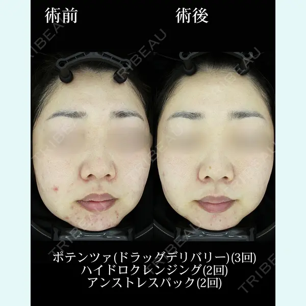 HAAB×DREAM BEAUTY CLINIC 東京本院の症例