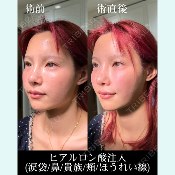 HAAB×DREAM BEAUTY CLINIC 大阪梅田院 錦 実奈医師の症例