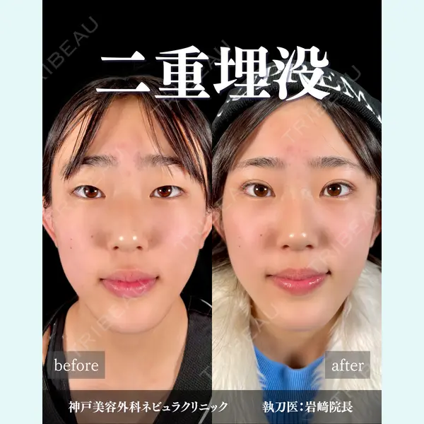神戸美容外科 ネビュラクリニック 岩﨑 雅医師の症例