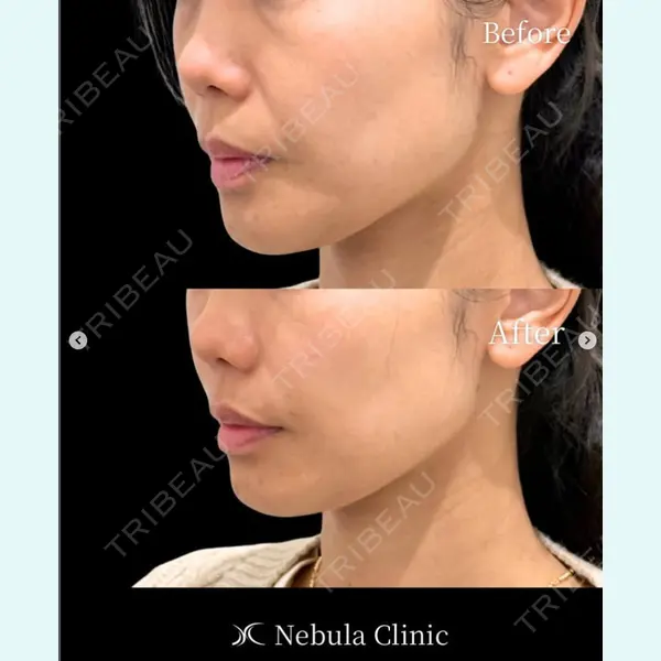 愛知春日井美容外科ネビュラクリニック 都築 諒医師の症例