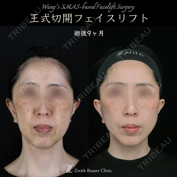 Zetith Beauty Clinic 新宿院 王 蘇医師の症例
