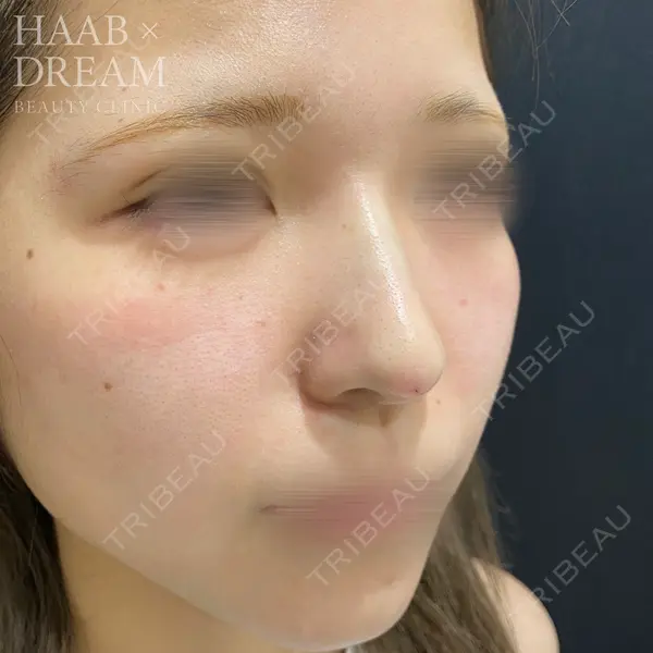 HAAB×DREAM BEAUTY CLINIC 東京本院 田中 優太医師の症例