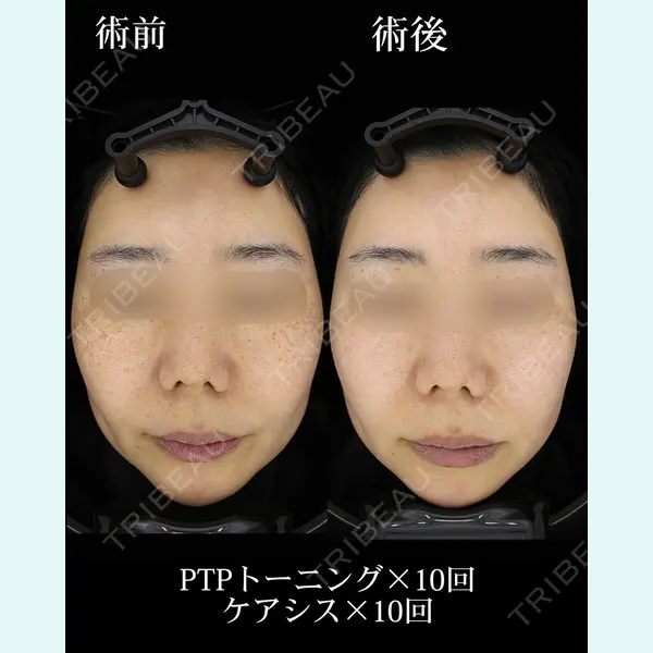 HAAB×DREAM BEAUTY CLINIC 大阪梅田院の症例