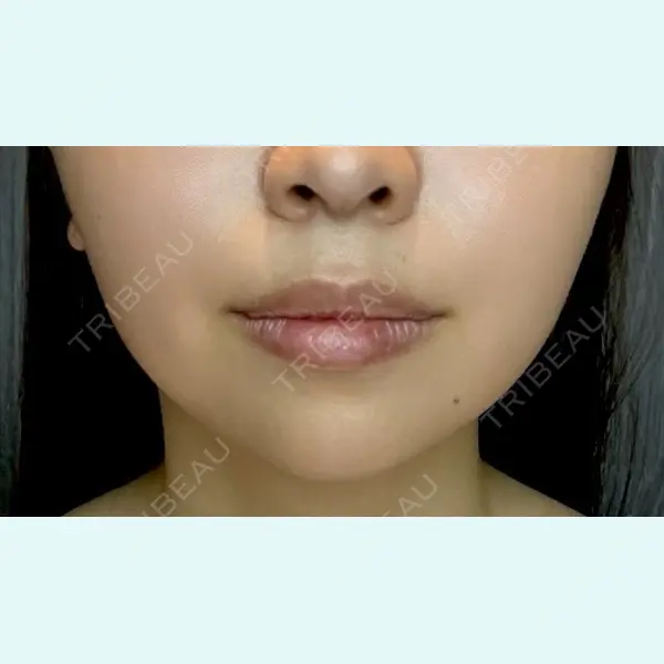 REVI CLINIC銀座院 の症例