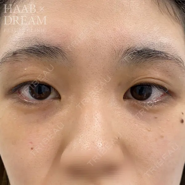 HAAB×DREAM BEAUTY CLINIC 東京本院 田中 優太医師の症例