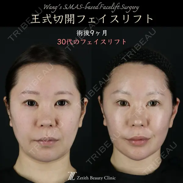 Zetith Beauty Clinic 新宿院 王 蘇医師の症例