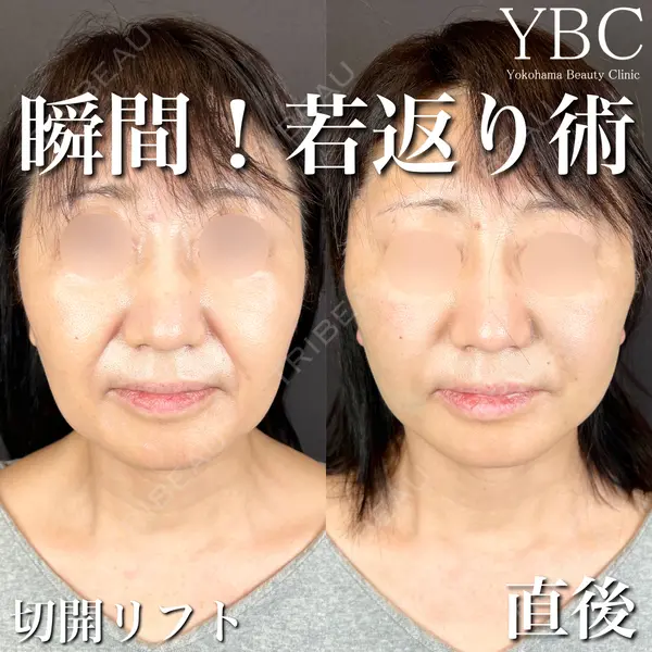 YBC横浜美容外科 池袋院 磯村 亮輔医師の症例