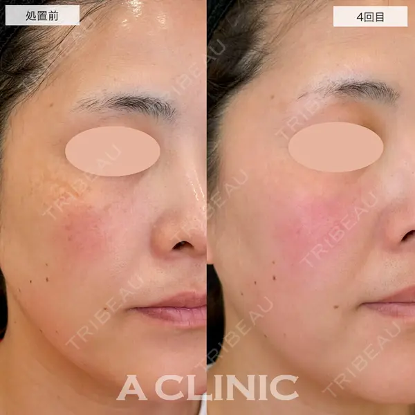 A CLINIC（エークリニック） 仙台院 伊藤 瑠桂医師の症例