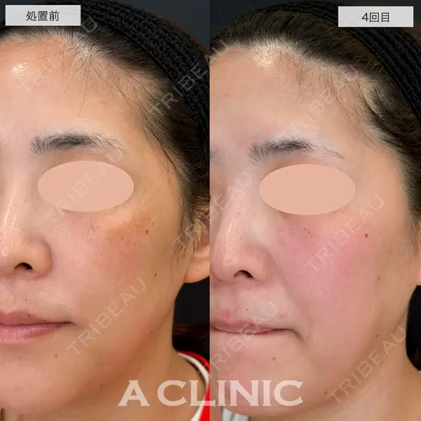 A CLINIC（エークリニック） 仙台院 伊藤 瑠桂医師の症例