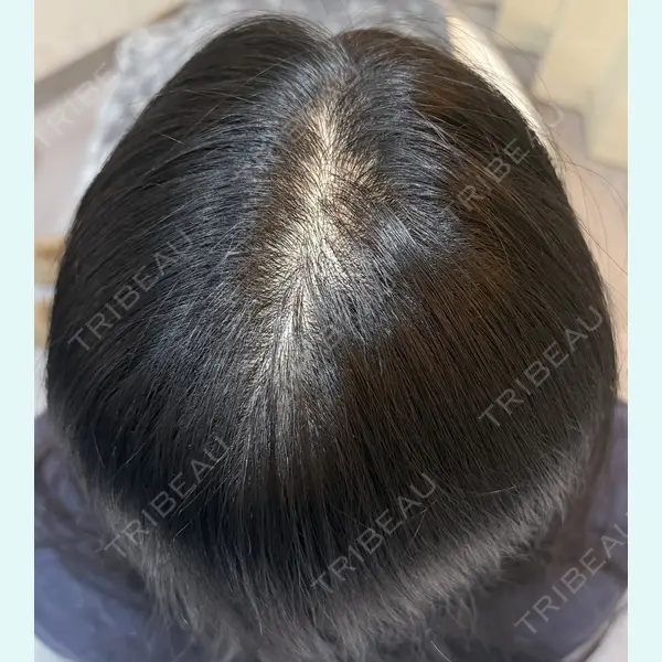 One Hair Artmake(One Beauty Clinic) 大塚 みさ医師の症例