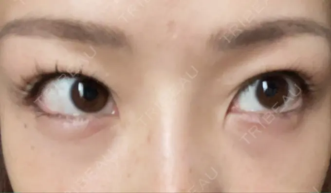 クマ治療 品川美容外科 新宿院（※品川スキンクリニック提携） DAY 8 メイン用