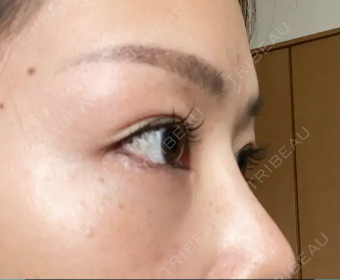 クマ治療 品川美容外科 新宿院（※品川スキンクリニック提携） DAY 8 メイン用