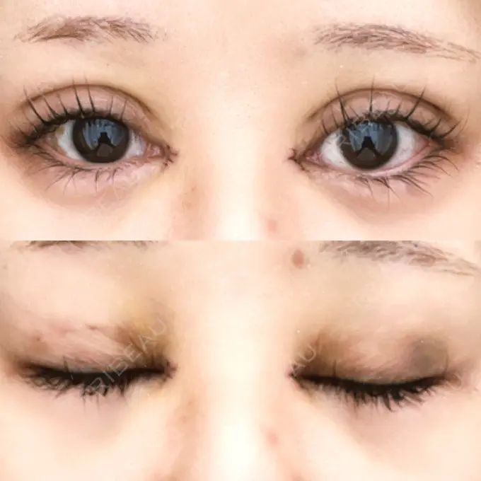 二重埋没 / 目頭切開 Brandnew Beauty Clinic DAY 3 メイン用