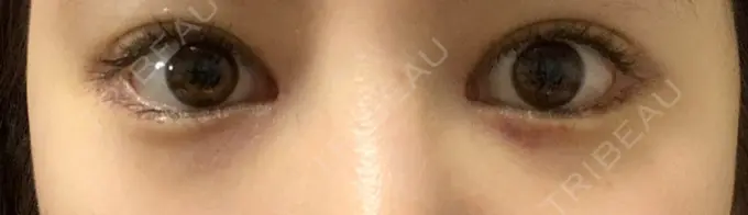 目頭切開 / 目尻切開 / 目尻靭帯移動 DIVINE（ディバイン）整形外科 DAY 9 メイン用