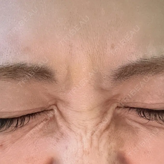 ボトックス（眉間） / その他（鼻） TCB東京中央美容外科 青森院 DAY 4 メイン用