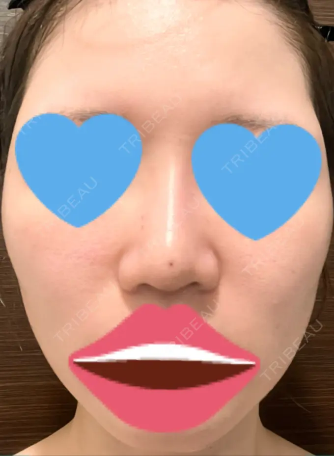 隆鼻術 / ボトックス（エラ・小顔） TCB東京中央美容外科 福岡博多院 DAY 5 メイン用