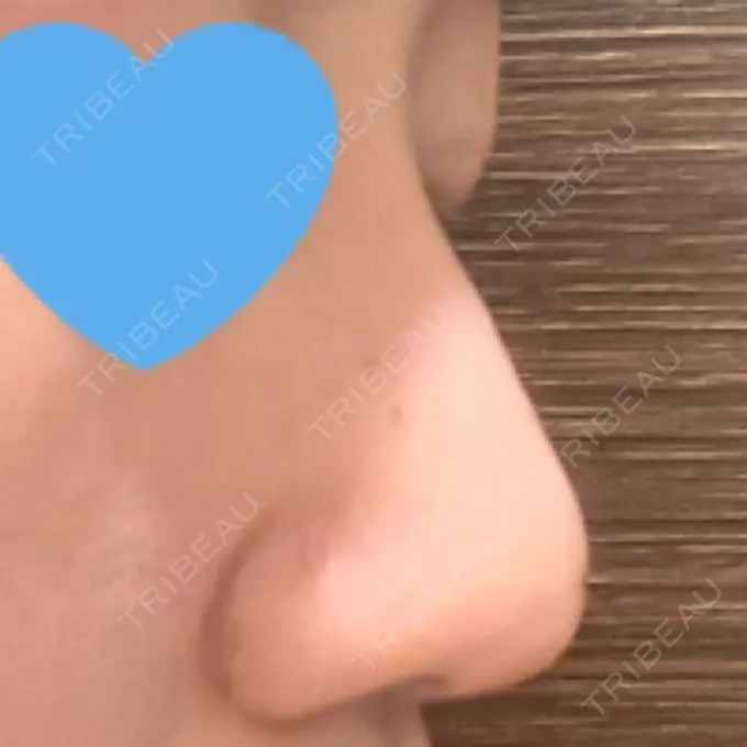 隆鼻術 / ボトックス（エラ・小顔） TCB東京中央美容外科 福岡博多院 DAY 5 メイン用