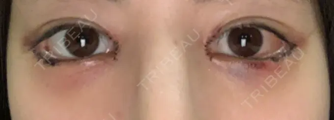 目頭切開 / 目尻切開 / 目尻靭帯移動 DIVINE（ディバイン）整形外科 DAY 2 メイン用