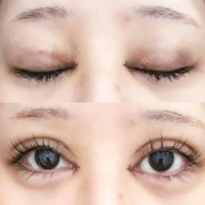 二重埋没 / 目頭切開 Brandnew Beauty Clinic DAY 4 メイン用