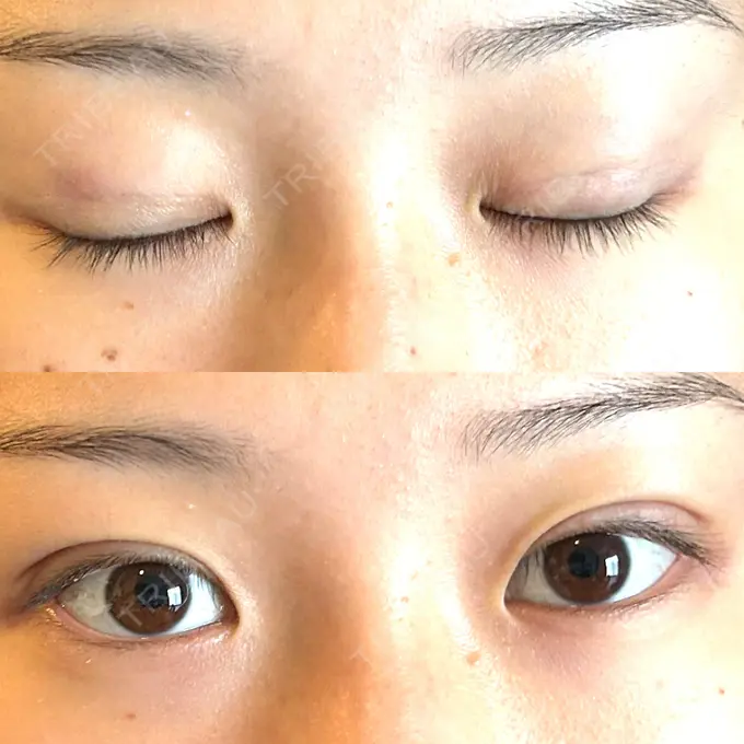 二重埋没 湘南美容クリニック 京都院 DAY 2 メイン用