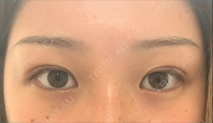 二重埋没 湘南美容クリニック 京都院 AFTER メイン用