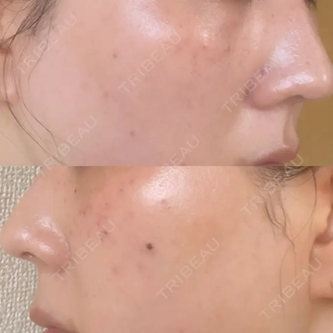 ルメッカ ルラ美容クリニック 上野院 DAY 0 メイン用