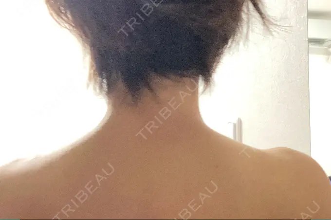 ボトックス（肩） TCB東京中央美容外科 京都駅前院 AFTER メイン用