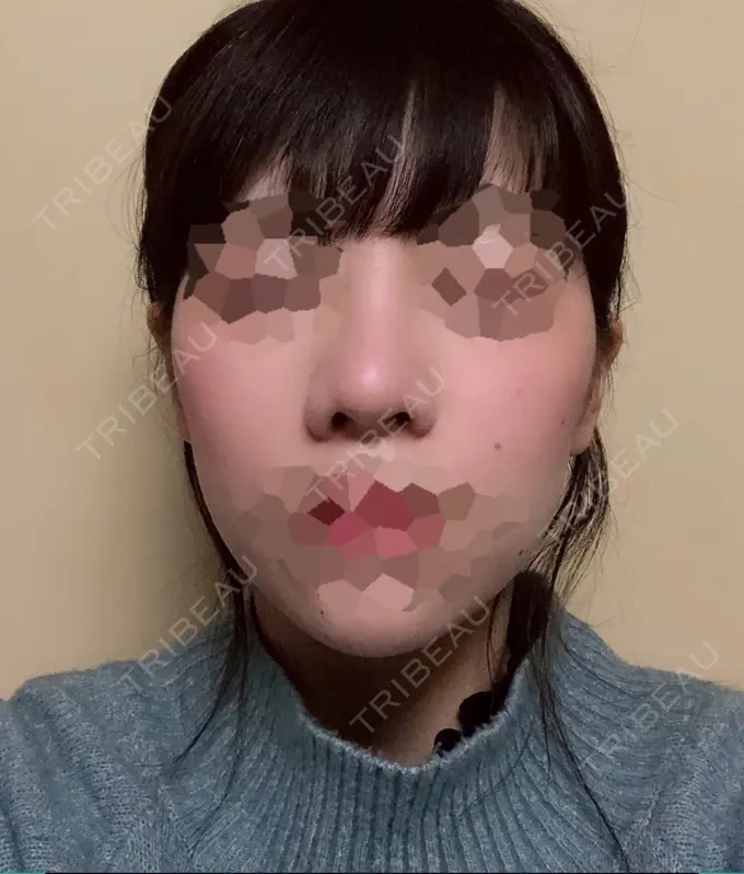 隆鼻術 / 鼻尖形成（切開） / 小鼻縮小（切開） 湘南美容クリニック 岡山院 DAY 62 メイン用