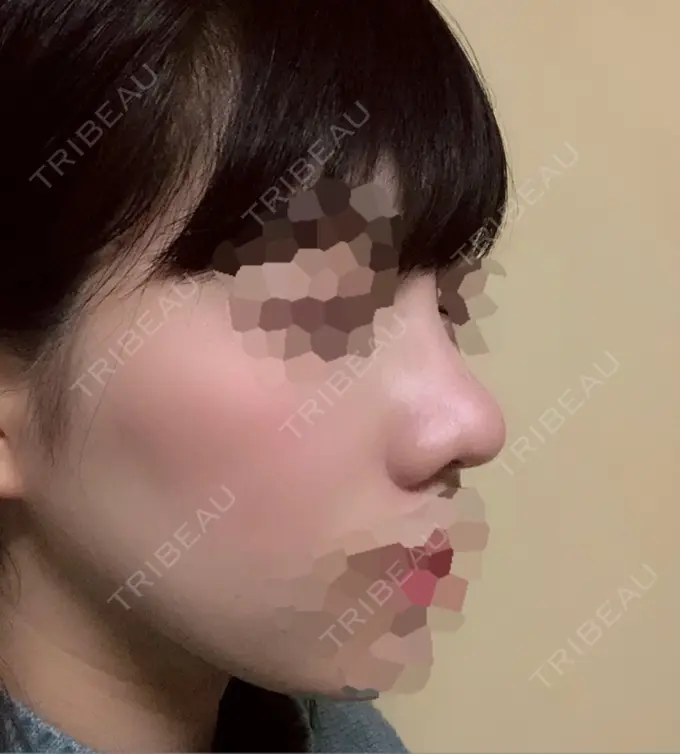 隆鼻術 / 鼻尖形成（切開） / 小鼻縮小（切開） 湘南美容クリニック 岡山院 DAY 62 メイン用