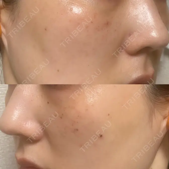 ルメッカ ルラ美容クリニック 上野院 DAY 2 メイン用