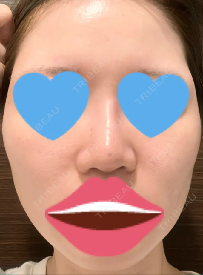 隆鼻術 / ボトックス（エラ・小顔） TCB東京中央美容外科 福岡博多院 DAY 7 メイン用