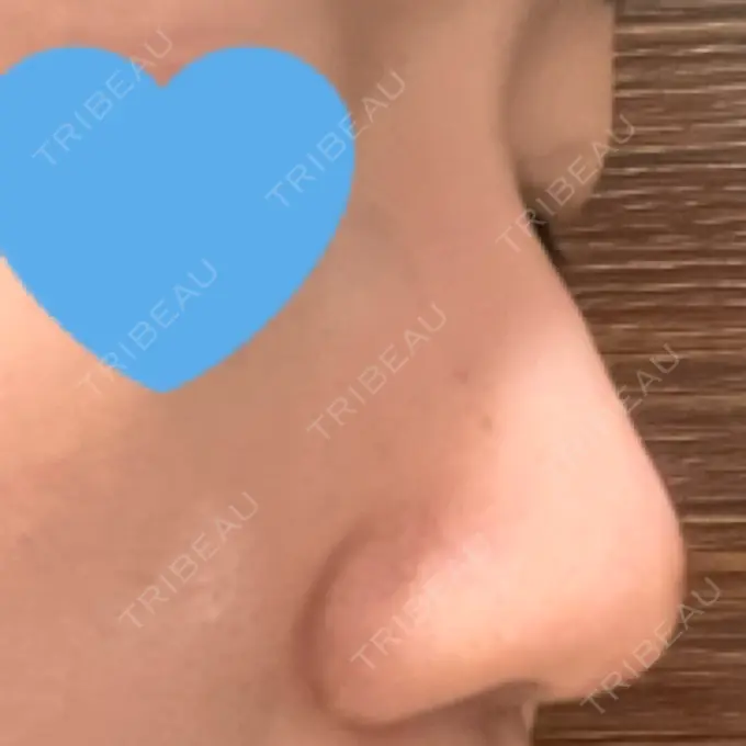 隆鼻術 / ボトックス（エラ・小顔） TCB東京中央美容外科 福岡博多院 DAY 7 メイン用