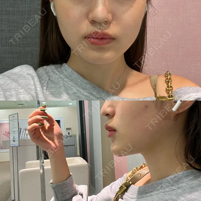 糸リフト / 脂肪吸引（顔） Casa de GRACIA GINZA 【カーサデグラシアギンザ】 DAY 17 メイン用