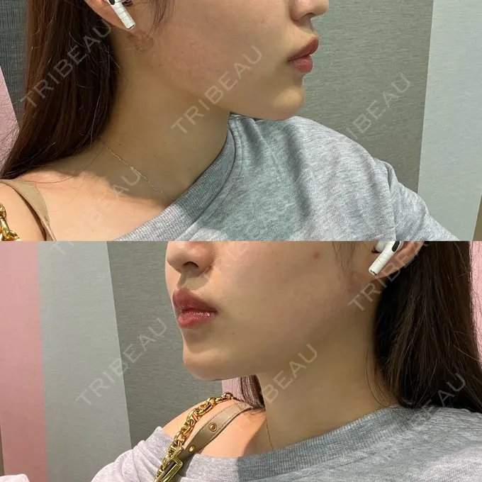 糸リフト / 脂肪吸引（顔） Casa de GRACIA GINZA 【カーサデグラシアギンザ】 DAY 17 メイン用