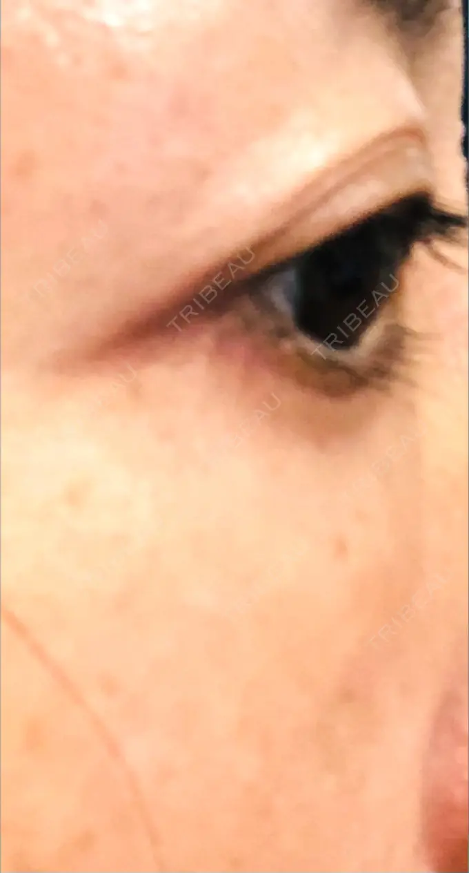 クマ治療 / 下まぶたたるみ取り / 脂肪注入（目の下） 湘南美容クリニック Regno 銀座院 DAY 48 メイン用