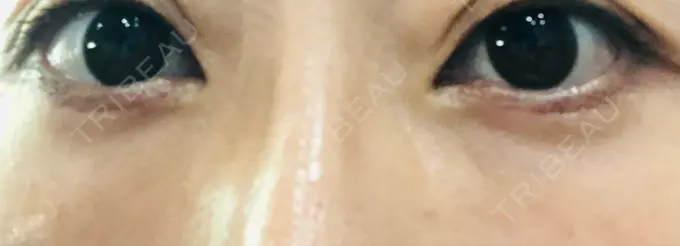 クマ治療 / 下まぶたたるみ取り / 脂肪注入（目の下） 湘南美容クリニック Regno 銀座院 DAY 48 メイン用