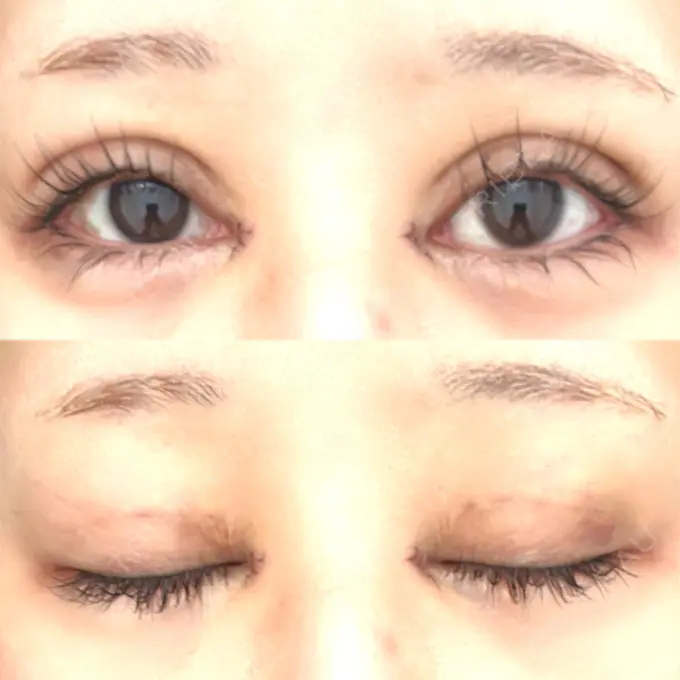 二重埋没 / 目頭切開 Brandnew Beauty Clinic DAY 6 メイン用