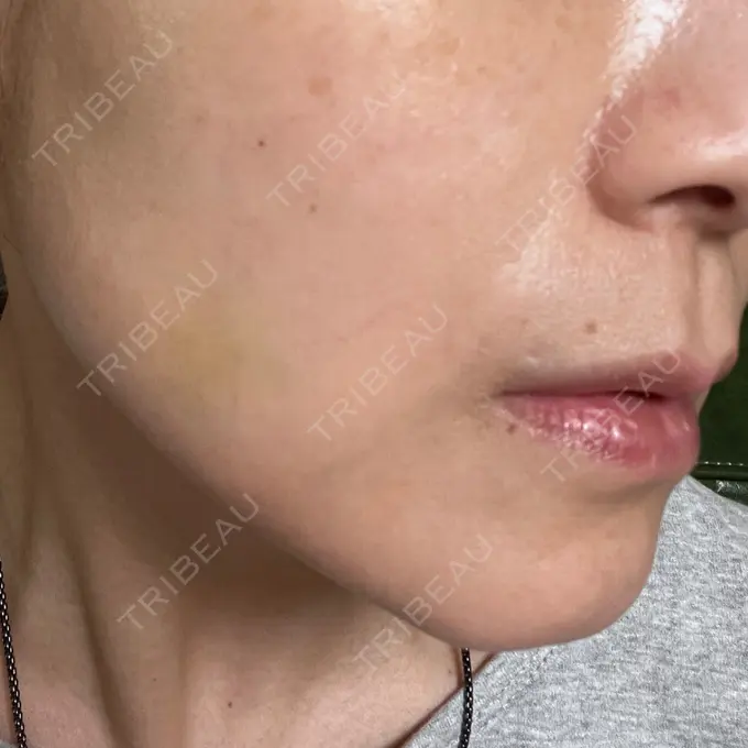 糸リフト 東京シンデレラ美容外科 池袋院 DAY 12 メイン用