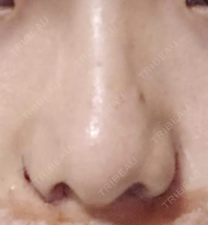 小鼻縮小（切開） 宇都宮ひふ科形成外科 DAY 3 メイン用