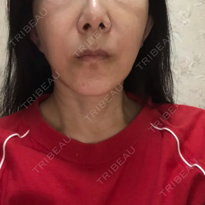 脂肪溶解注射（顔） 表参道ウィズ・クリニック AFTER メイン用