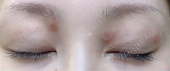 ピコレーザートーニング（美白・肝斑） / ピコスポット 日比谷セントラルクリニック DAY 1 メイン用