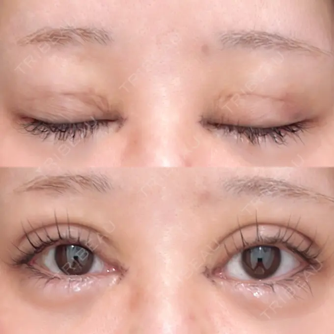 二重埋没 / 目頭切開 Brandnew Beauty Clinic DAY 7 メイン用