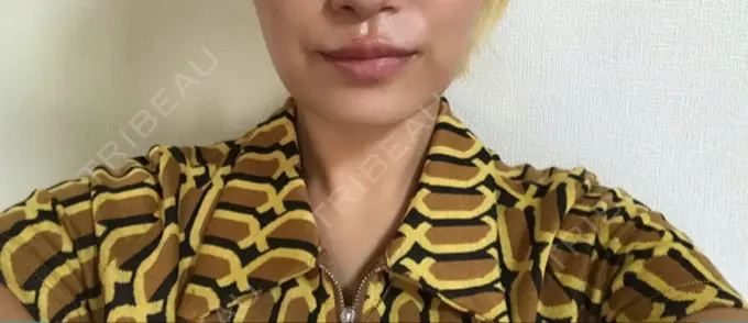 ヒアルロン酸注入（唇） 日本ウェルネス再生クリニック DAY 32 メイン用